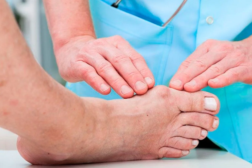 post-operatorio de una cirugía de Juanetes